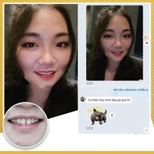 Feedback của khách hàng dán sứ Veneer tại VNPC