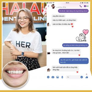 Feedback của khách hàng dán sứ Veneer tại VNPC