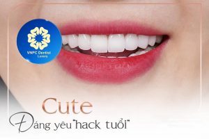 Chỉnh nha mắc cài