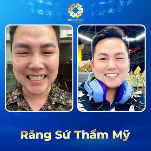 Răng sứ thẩm mỹ