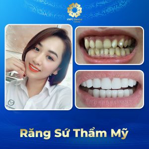 Răng sứ thẩm mỹ