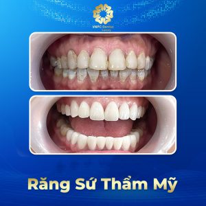 Răng sứ thẩm mỹ