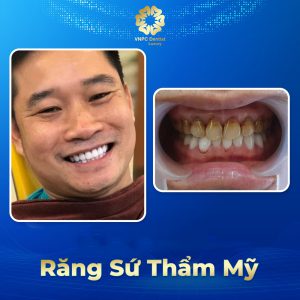 Răng sứ thẩm mỹ