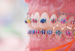 Niềng răng mắc cài sứ – Đối tượng, chi phí và đánh giá ưu nhược điểm