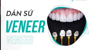 Dán răng sứ Veneer